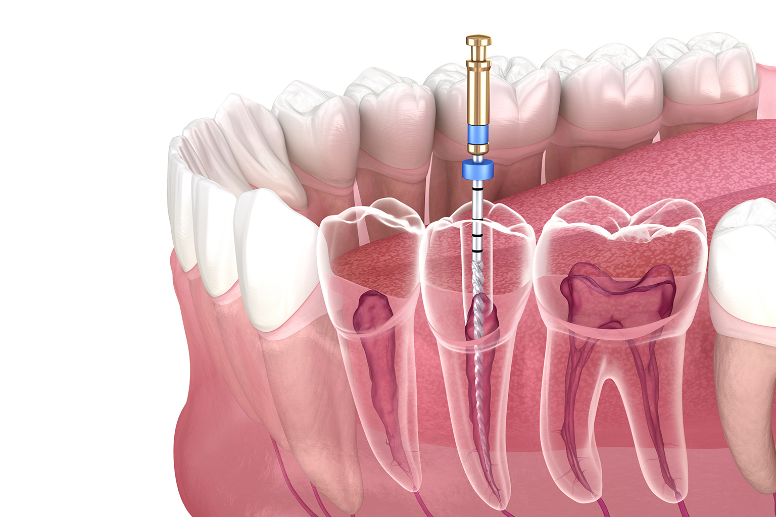 Root Canal Treatment Process